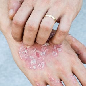 Man scratch oneself, dry flaky skin on hand with psoriasis vulgaris, eczema and other skin conditions like fungus, plaque, rash and patches. Autoimmune genetic disease.